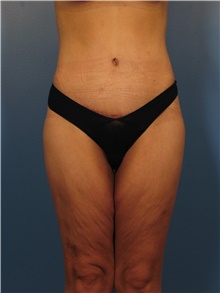 Body Lift After Photo by Eric Mariotti, MD; Concord, CA - Case 40185