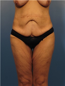 Body Lift Before Photo by Eric Mariotti, MD; Concord, CA - Case 40185