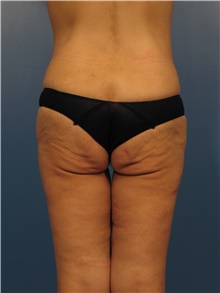 Body Lift Before Photo by Eric Mariotti, MD; Concord, CA - Case 40185