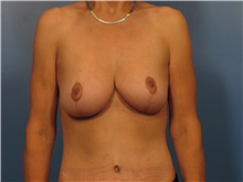 Body Lift After Photo by Eric Mariotti, MD; Concord, CA - Case 40185