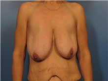 Body Lift Before Photo by Eric Mariotti, MD; Concord, CA - Case 40185