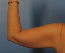 Liposuction After Photo by Eric Mariotti, MD; Concord, CA - Case 40987