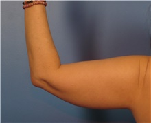 Liposuction Before Photo by Eric Mariotti, MD; Concord, CA - Case 40987