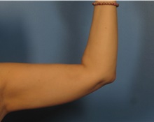Liposuction After Photo by Eric Mariotti, MD; Concord, CA - Case 40987