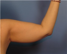 Liposuction Before Photo by Eric Mariotti, MD; Concord, CA - Case 40987