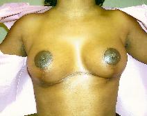Breast Lift After Photo by Gregory Morrison, MD; Dublin, OH - Case 7684