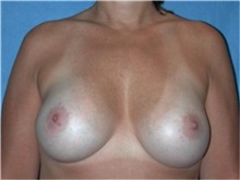 Breast Augmentation After Photo by Frank Barone, MD; Toledo, OH - Case 31760