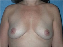 Breast Augmentation Before Photo by Frank Barone, MD; Toledo, OH - Case 31760