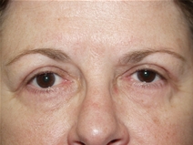 Eyelid Surgery After Photo by Lawrence Gray, MD; Portsmouth, NH - Case 20169