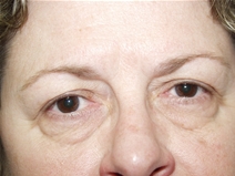 Eyelid Surgery Before Photo by Lawrence Gray, MD; Portsmouth, NH - Case 20169