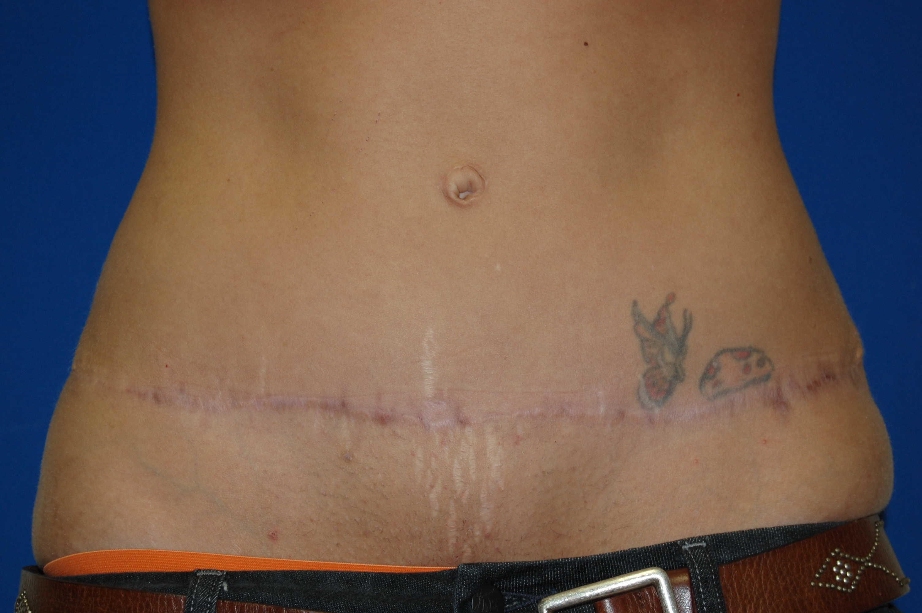 Tummy Tuck Before and After Photos by Lawrence Gray, MD; Portsmouth, NH -  Case 20170 | ASPS