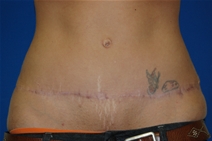 Tummy Tuck After Photo by Lawrence Gray, MD; Portsmouth, NH - Case 20170