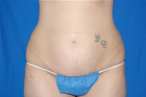 Tummy Tuck Before Photo by Lawrence Gray, MD; Portsmouth, NH - Case 20170