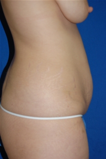 Tummy Tuck Before Photo by Lawrence Gray, MD; Portsmouth, NH - Case 20170