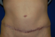 Tummy Tuck After Photo by Lawrence Gray, MD; Portsmouth, NH - Case 20171