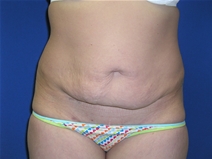 Tummy Tuck Before Photo by Lawrence Gray, MD; Portsmouth, NH - Case 20171