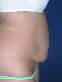 Tummy Tuck Before Photo by Lawrence Gray, MD; Portsmouth, NH - Case 20171