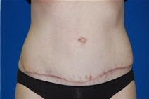 Tummy Tuck After Photo by Lawrence Gray, MD; Portsmouth, NH - Case 20172