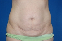 Tummy Tuck Before Photo by Lawrence Gray, MD; Portsmouth, NH - Case 20172