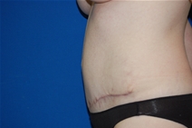 Tummy Tuck After Photo by Lawrence Gray, MD; Portsmouth, NH - Case 20172