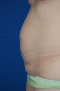 Tummy Tuck Before Photo by Lawrence Gray, MD; Portsmouth, NH - Case 20172