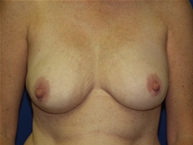 Breast Reduction After Photo by Lawrence Gray, MD; Portsmouth, NH - Case 20173