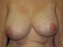 Breast Reduction Before Photo by Lawrence Gray, MD; Portsmouth, NH - Case 20173