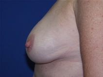 Breast Reduction After Photo by Lawrence Gray, MD; Portsmouth, NH - Case 20173