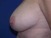 Breast Reduction Before Photo by Lawrence Gray, MD; Portsmouth, NH - Case 20173