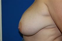 Breast Reduction After Photo by Lawrence Gray, MD; Portsmouth, NH - Case 20174