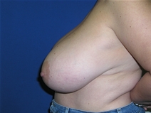 Breast Reduction Before Photo by Lawrence Gray, MD; Portsmouth, NH - Case 20174
