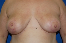 Breast Reduction After Photo by Lawrence Gray, MD; Portsmouth, NH - Case 20175