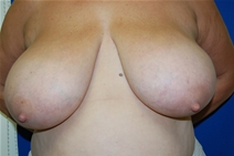 Breast Reduction Before Photo by Lawrence Gray, MD; Portsmouth, NH - Case 20175