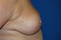Breast Reduction After Photo by Lawrence Gray, MD; Portsmouth, NH - Case 20175