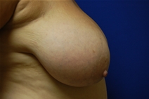 Breast Reduction Before Photo by Lawrence Gray, MD; Portsmouth, NH - Case 20175