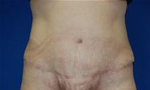 Tummy Tuck After Photo by Lawrence Gray, MD; Portsmouth, NH - Case 20735