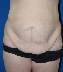 Tummy Tuck Before Photo by Lawrence Gray, MD; Portsmouth, NH - Case 20735