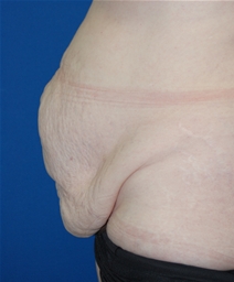 Tummy Tuck Before Photo by Lawrence Gray, MD; Portsmouth, NH - Case 20735