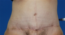 Tummy Tuck After Photo by Lawrence Gray, MD; Portsmouth, NH - Case 20736