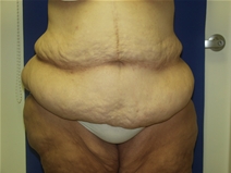 Tummy Tuck Before Photo by Lawrence Gray, MD; Portsmouth, NH - Case 20736