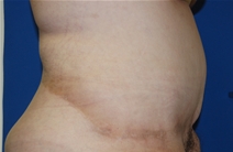 Tummy Tuck After Photo by Lawrence Gray, MD; Portsmouth, NH - Case 20736