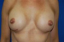 Breast Augmentation After Photo by Lawrence Gray, MD; Portsmouth, NH - Case 20790