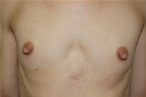 Breast Augmentation Before Photo by Lawrence Gray, MD; Portsmouth, NH - Case 20790