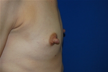 Breast Augmentation Before Photo by Lawrence Gray, MD; Portsmouth, NH - Case 20790