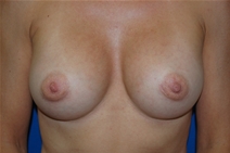 Breast Augmentation After Photo by Lawrence Gray, MD; Portsmouth, NH - Case 20791