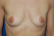 Breast Augmentation Before Photo by Lawrence Gray, MD; Portsmouth, NH - Case 20791