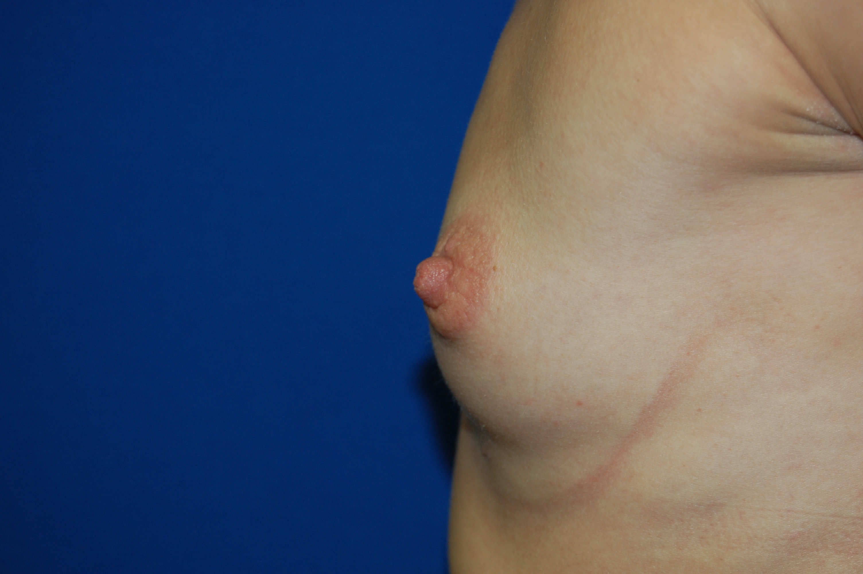 Breast Augmentation Before and After Photos by Lawrence Gray MD