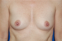 Breast Augmentation Before Photo by Lawrence Gray, MD; Portsmouth, NH - Case 21819