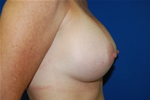 Breast Augmentation After Photo by Lawrence Gray, MD; Portsmouth, NH - Case 21819