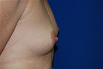 Breast Augmentation Before Photo by Lawrence Gray, MD; Portsmouth, NH - Case 21819